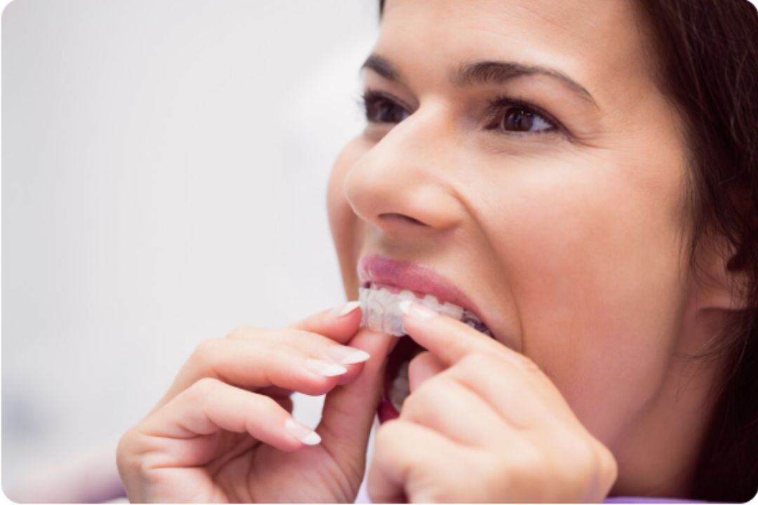 invisalign aligner care guide expert tips and benefits